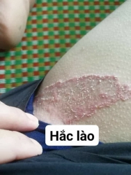 c loại bệnh da tại Quảng Nam