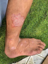  Ngứa điên đảo, càng tại Quảng Nam