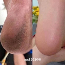 Chăm sóc gót chân bằng phương pháp tẩy tế bào chết tại Quảng Nam