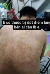Thuốc đặc trị bạch biến, lang bền gia truyền tại Quảng Nam