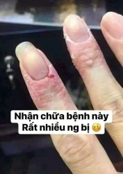 Thuốc trị ghẻ nước hiệu quả tại Quảng Nam