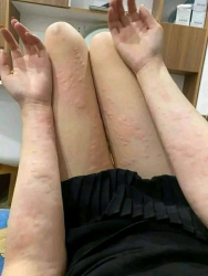 Dị ứng ngứa cơ thể tại Quảng Nam