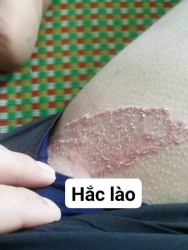 Chỉ 1 liệu trình thuốc, khỏi vĩnh viêm da cơ địa tại Quảng Nam