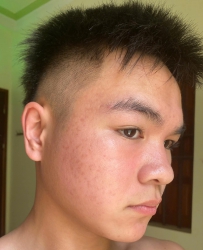 Điều trị mụn nám tàn nhang tại Quảng Nam