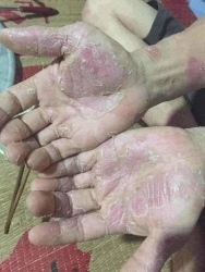ch trị thì ib mình bày cho nha tại Quảng Nam