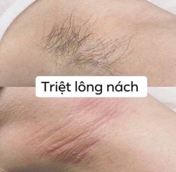 Triệt Lông Trẻ Hóa tại Quảng Nam