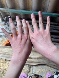Dị ứng mẩn ngứa, chữa khắp nơi không khói, yên tâm nhé cả nhà tại Quảng Nam