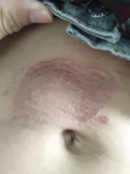 Chữa bệnh viêm da cơ địa hiệu quả tại Quảng Nam