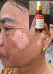 Đặc trị bạch biến lang ben Chỉ cần 1 lọ trị dứt điểm trong 10 ngày Ai cần i.b nhe.Cam kết 100% ko tại Quảng Nam