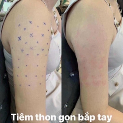 Tiêm Botox Thon Gọn Các Vùng tại Quảng Nam
