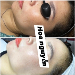 Trị da cho khách sau 1 liệu trình trùng tu nhà BÔNG tại Quảng Nam