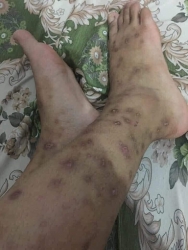 Cần giúp đỡ với vấn đề về sẹo, thâm và ngứa tại Quảng Nam