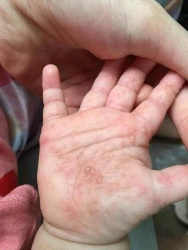 Thuốc đặc trị gãi bọng nước không tái phát tại Quảng Nam