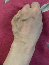 Thuốc trị dứt điểm bệnh SUY GIÃN TĨNH MẠCH tại Quảng Nam