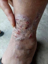 Thuốc đặc trị nhiều bệnh da tại Quảng Nam