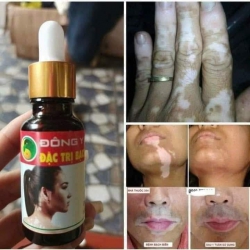 Thuốc đặc trị bạch biến, lang ben gia truyền tại Quảng Nam