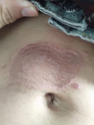 Ngứa càng gãi càng ngứa tại Quảng Nam