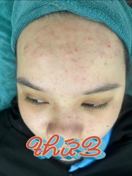 Em khoe khách làm Mặt Không Tiêm tại Quảng Nam