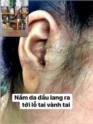 Đặc trị Nấm vảy nến tại Quảng Nam