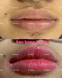 Nền môi thâm nặng mà kết quả như này thì có quá tuyệt vời không? tại Quảng Nam