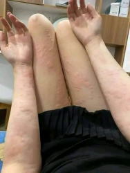 Nổi mề đay - Dị ứng tại Quảng Nam