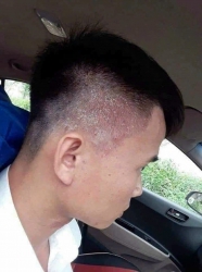 Chỉ 1 Tuýp Thuốc - Không Tái Phát tại Quảng Nam