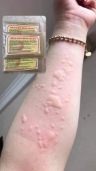 Ngứa dị ứng hoặc sán chó mèo uống thuốc tây không khỏi inb em có thuốc trị khỏi nha tại Quảng Nam