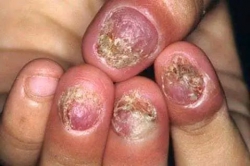 c bệnh nấm tại Quảng Nam